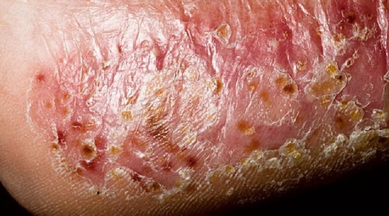 Dyshidrotic glivice stopal